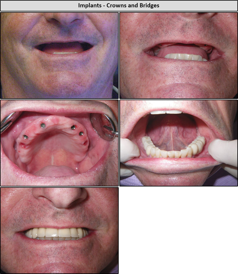 Before & After Implant Crowns And Bridges