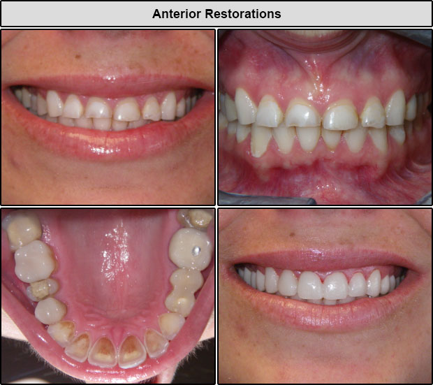 Before & After Anterior Restorations