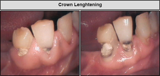 Before & After Crown Lengthening