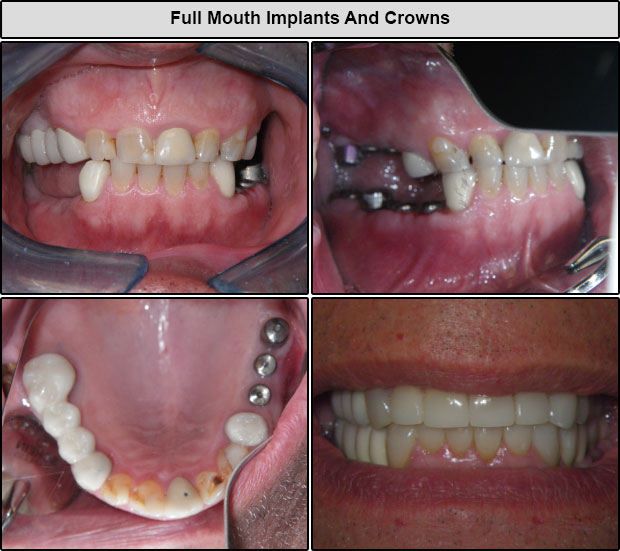 Before & After Full Mouth Implants And Crowns
