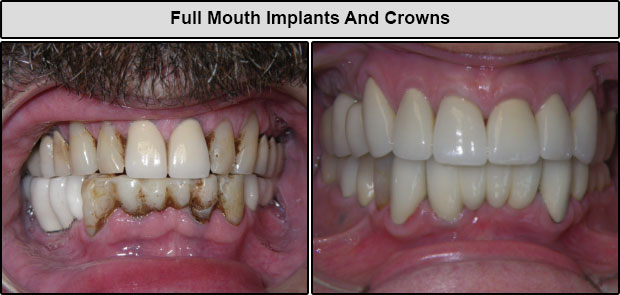Full Mouth Implants And Crowns