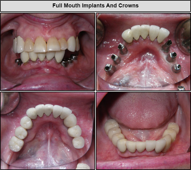 Implants And Crowns