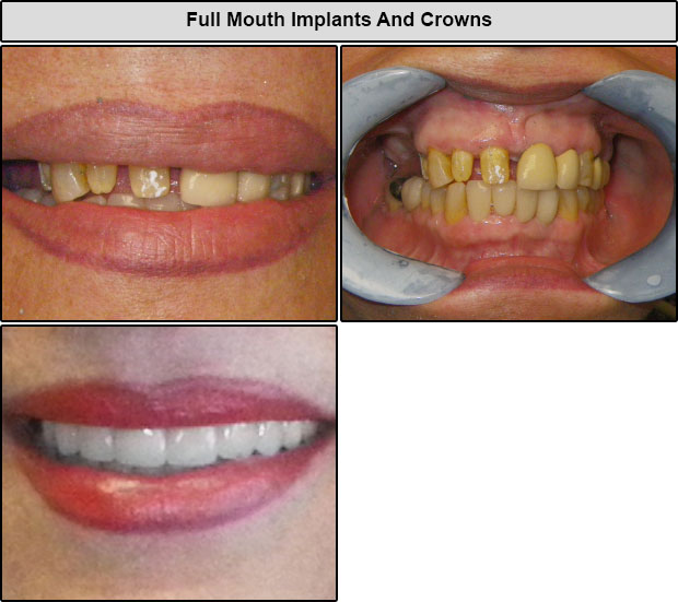 Full Implants And Crowns
