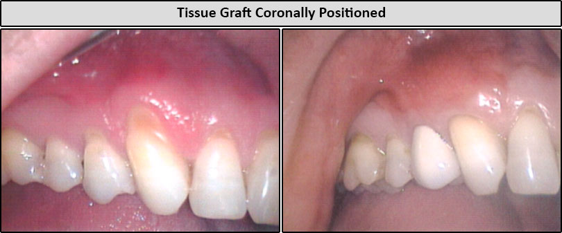 Before & After Tissue Graph