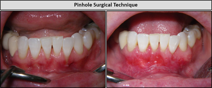 Before & After Pin Hole Surgery