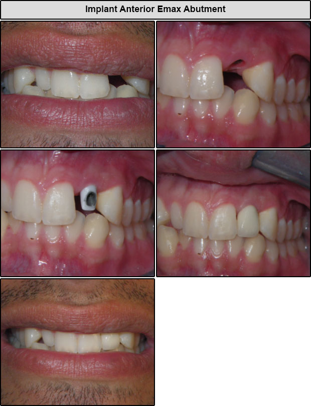 Before & After Anterior Implants