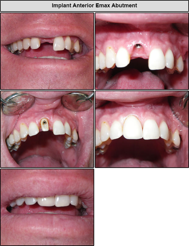 After Anterior Implants