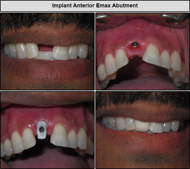 Before & After Anterior Dental Implants