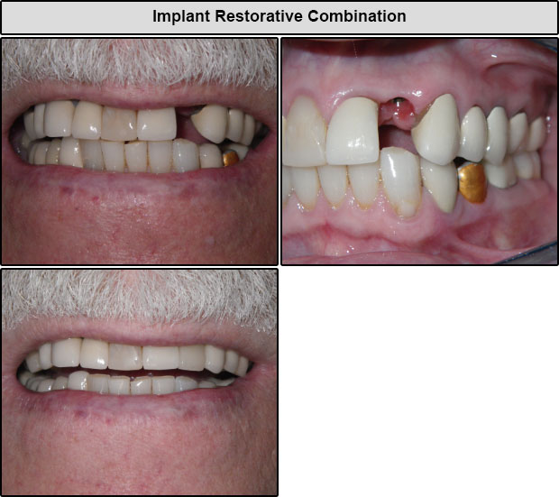 Before & After Implant Restorative Combination