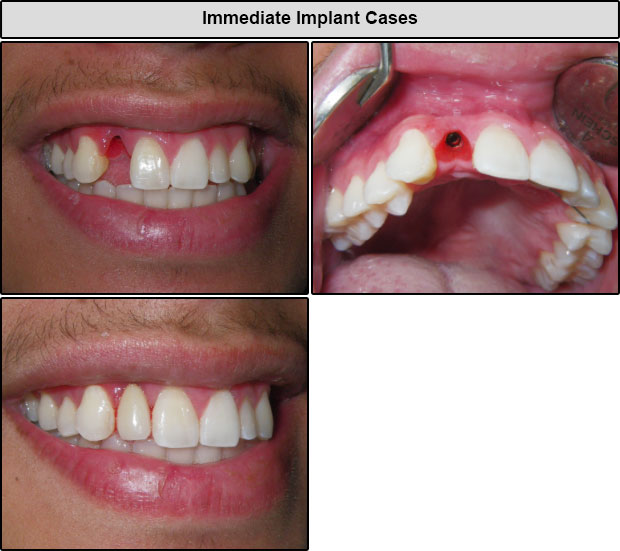 Before & After Immediate Implant Cases