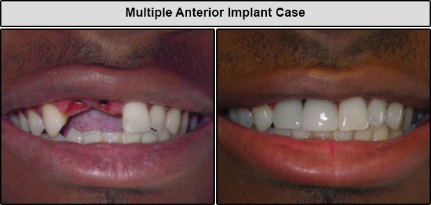 Anterior Dental Implants