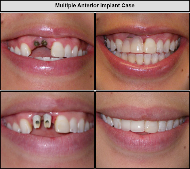 Anterior Implants