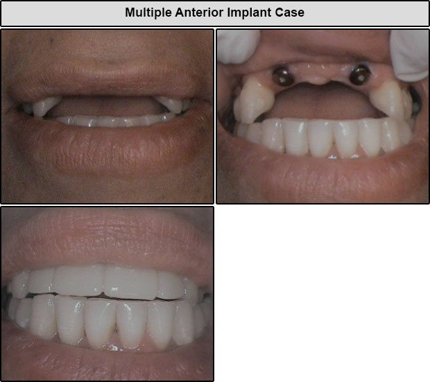 Before & After Anterior Implants