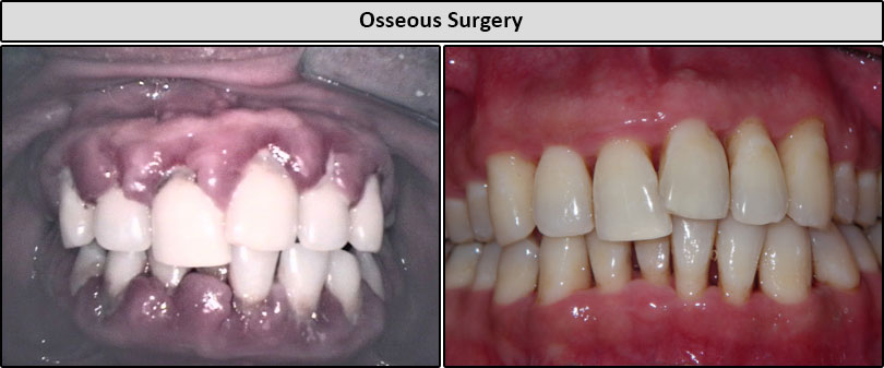 Before & After Osseous Surgery