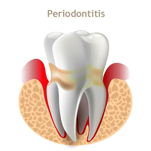 periodontitis