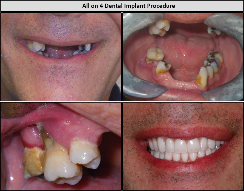 All On 4 Dental Implants