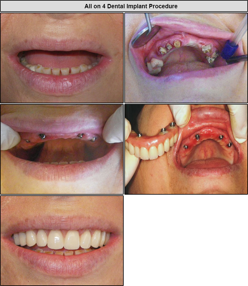  All On 4 Dental Implants