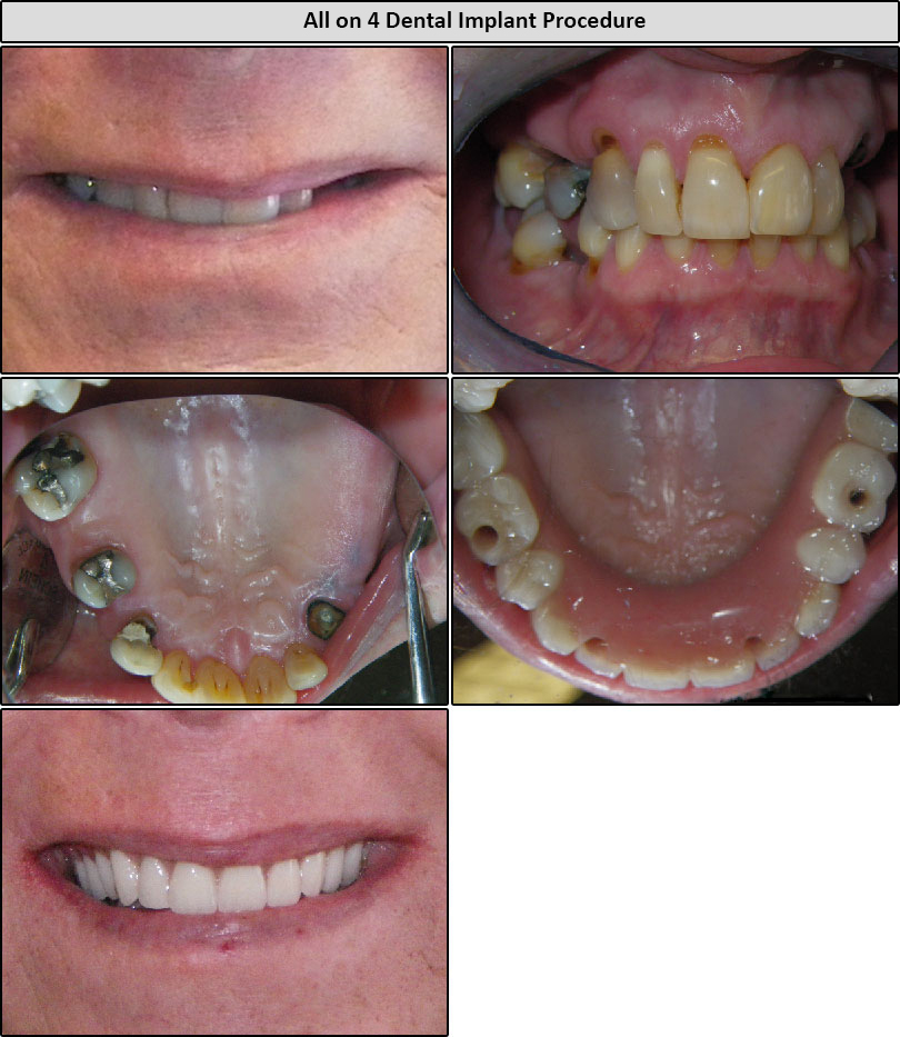 All On 4 Dental Implants