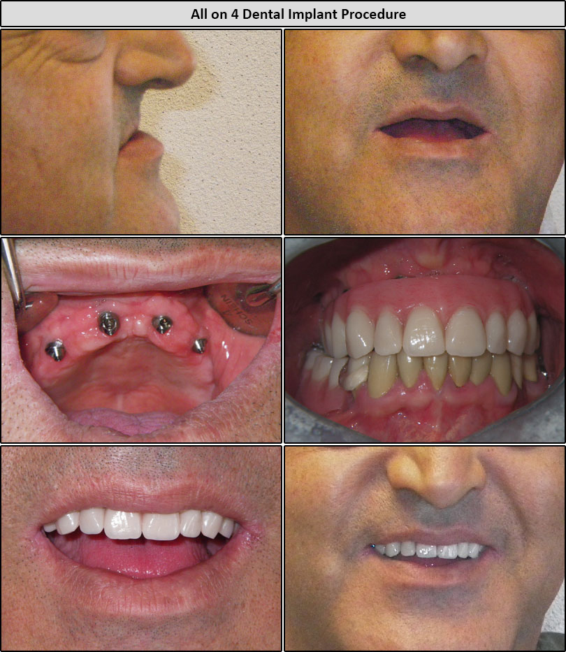 Before & After All On 4 Dental Implants