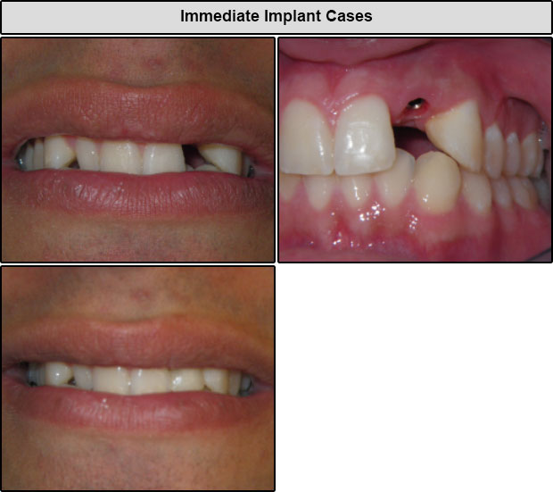 Immediate Implant Cases