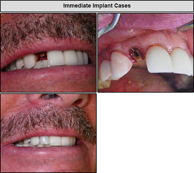 Immediate Dental Implant Cases