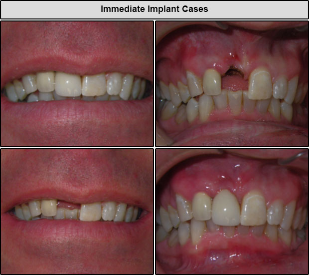 Dental Implant Cases