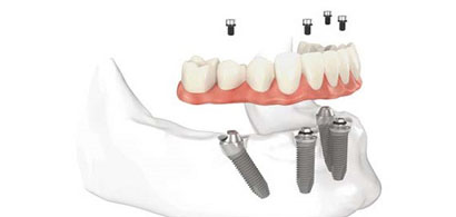 All on Four Dental Implants