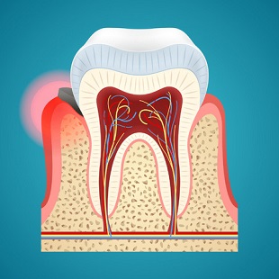 gum disease