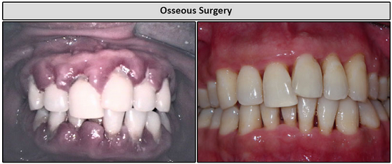 Osseous Surgery