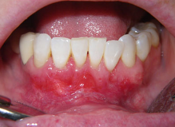 Pinhole Periodontal Disease Treatment